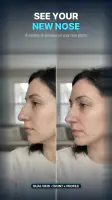 Nose Job - Plastic Surgery AI screenshot